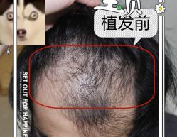 -大麦微针植发全国连锁