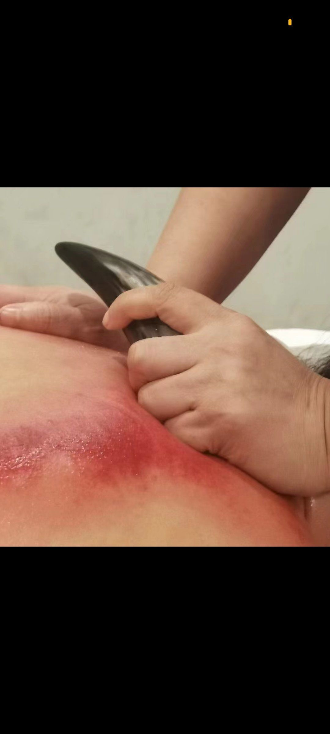 保持健康,从刮痧开始