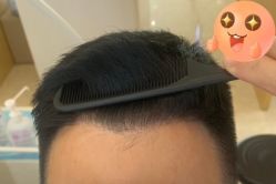 -大麦微针植发丨全国连锁