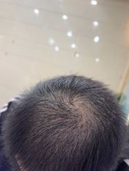 -碧莲盛·不剃发植发