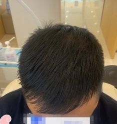 -大麦微针植发丨全国连锁