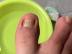 -世龙世家灰指甲鸡眼脚气甲沟炎跖疣护理(通州店)