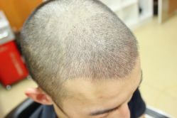 -大麦微针植发丨全国连锁