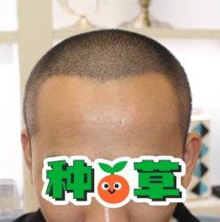 -大麦微针植发丨全国连锁