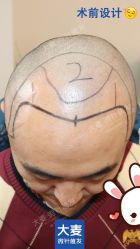 -大麦微针植发丨全国连锁