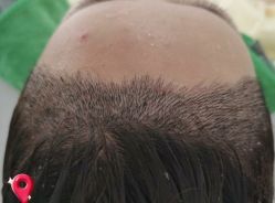 -大麦微针植发丨全国连锁