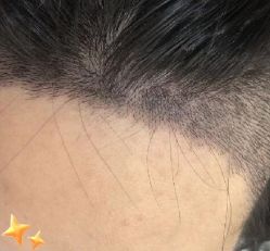 -大麦微针植发丨全国连锁