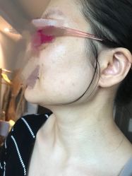 -美丽人生祛斑扁平疣汗管瘤中心