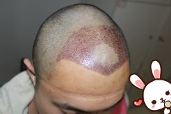 -大麦微针植发丨全国连锁