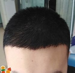 -大麦微针植发丨全国连锁