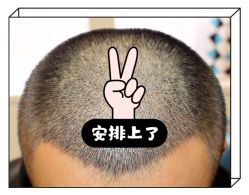 -大麦微针植发全国连锁