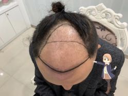 点击看大图 -大麦微针植发丨全国连锁