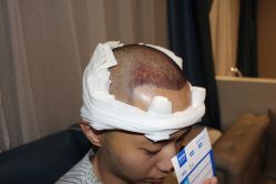 -大麦微针植发丨全国连锁