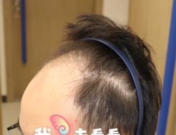 -大麦微针植发全国连锁