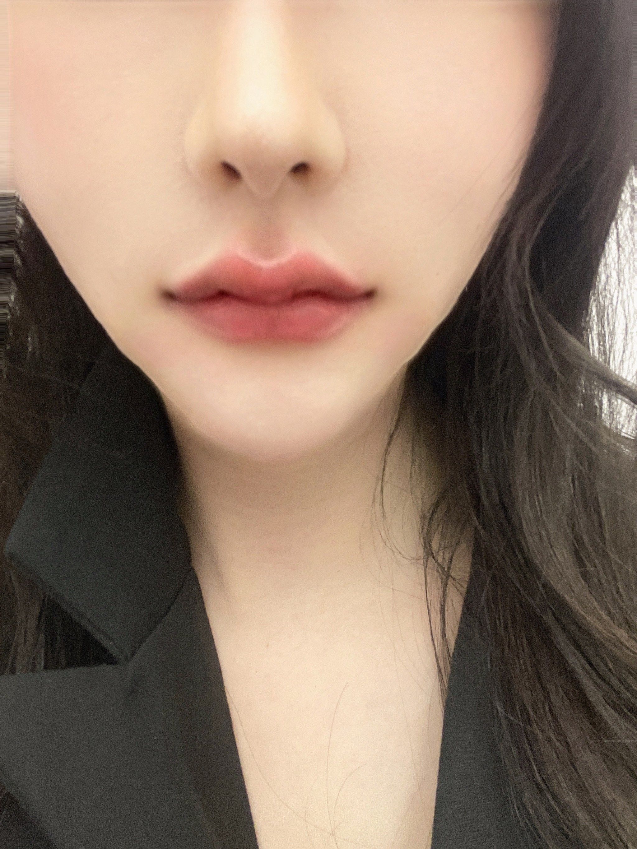 玻尿酸m字唇超级满意