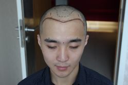 点击看大图 -大麦微针植发丨全国连锁