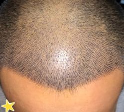 -大麦微针植发丨全国连锁