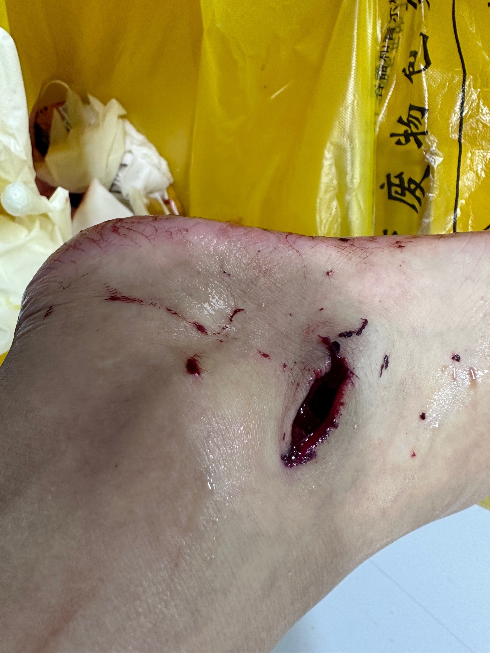 酒店玻璃爆炸导致身上多处受伤