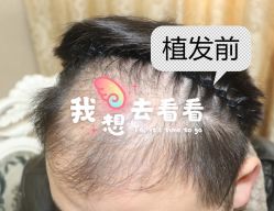 -大麦微针植发全国连锁