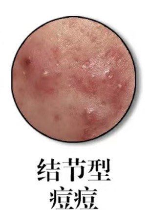 结节型痘痘怎么恢复?