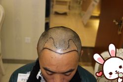 点击看大图 -大麦微针植发丨全国连锁