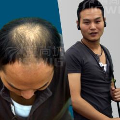 男士补发前后效果-髻尚坊增发补发织发假发定制