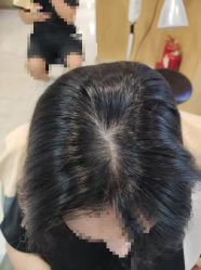 -大麦微针植发丨全国连锁