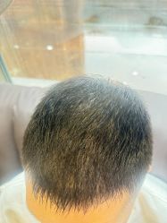 -碧莲盛·不剃发植发