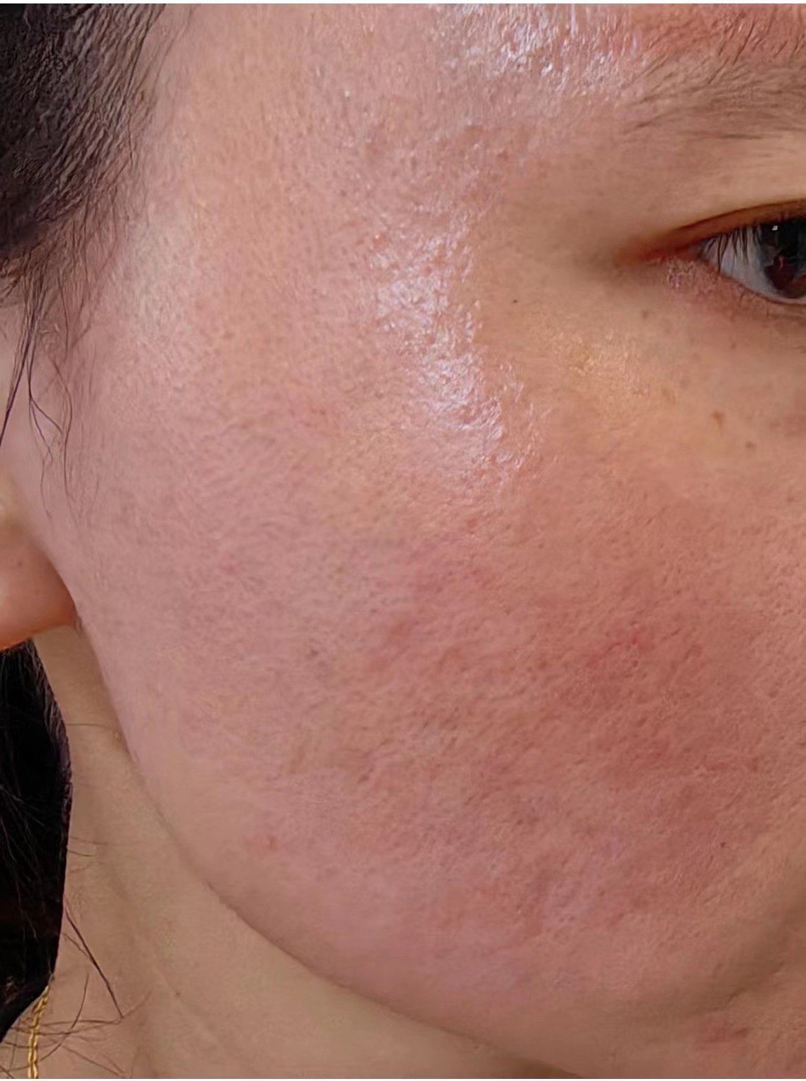 有没有刷酸泛红的姐妹有同款的吗