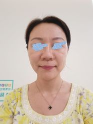 体验后-海涛医疗美容·面部抗衰·注射美鼻