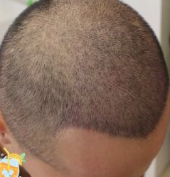 -大麦微针植发丨全国连锁