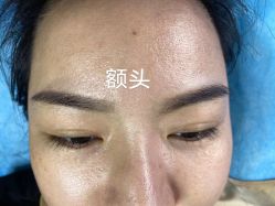 体验后-爱莎扁平疣·汗管瘤·斑痣中心