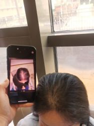 -碧莲盛·不剃发植发