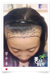 -大麦微针植发全国连锁