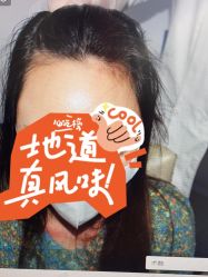 体验前-大麦微针植发丨全国连锁