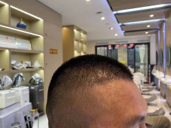 点击看大图 -大麦微针植发丨全国连锁