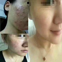 点击看大图 -苗方清颜·祛痘皮肤管理