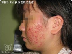 -韩医生专业祛痘连锁机构