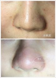 水氧清洁-光SPA科技美肤