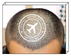 -大麦微针植发全国连锁