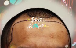 -大麦微针植发全国连锁