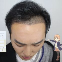 -大麦微针植发丨全国连锁