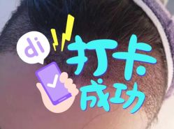 -大麦微针植发全国连锁
