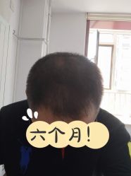 -北京雍禾植发医院