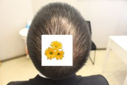 -大麦微针植发丨全国连锁