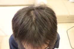 -大麦微针植发丨全国连锁