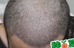 -大麦微针植发丨全国连锁