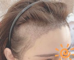 -大麦微针植发丨全国连锁