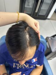 -大麦微针植发全国连锁