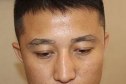 -大麦微针植发丨全国连锁